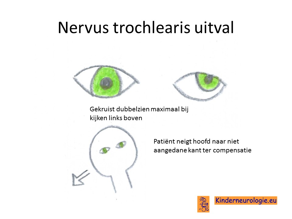 trochlearis nervus uitval trigeminus hersenzenuwen kinderneurologie oogbewegingen motore functie