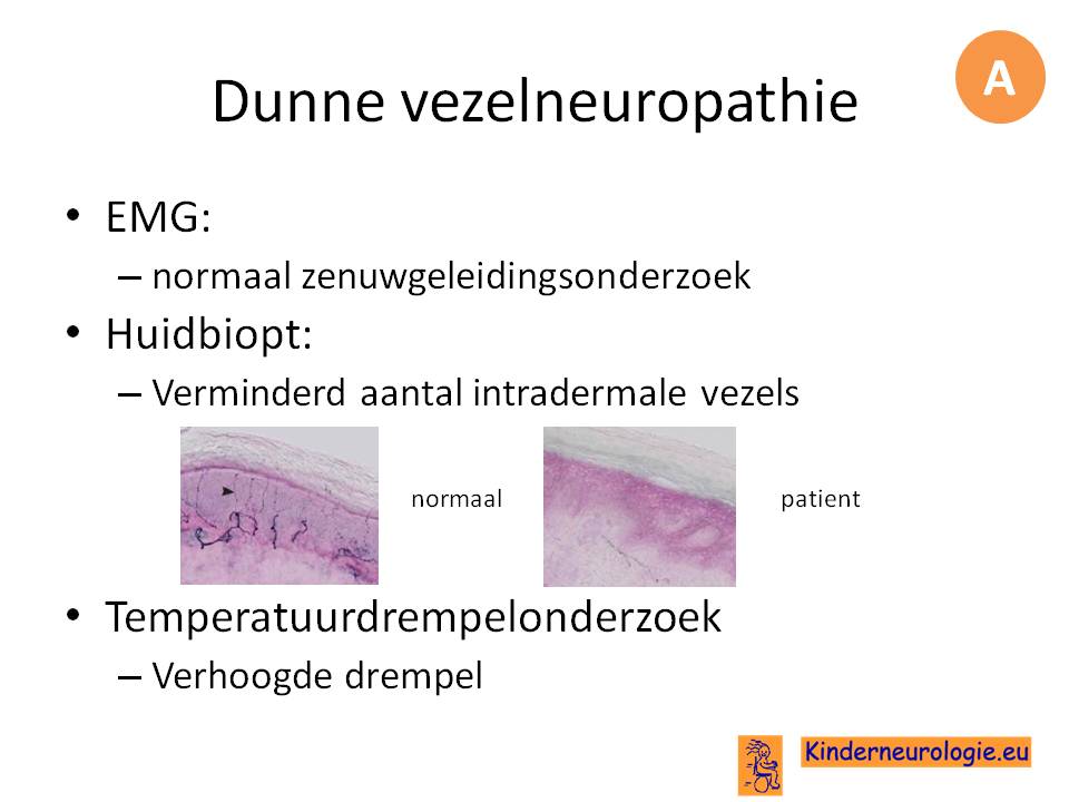 diagnostiek dunne vezelneuropathie