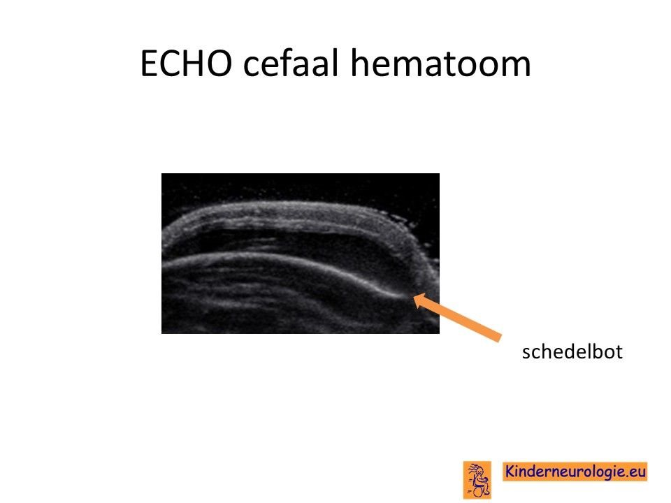 Cefaal Hematoom Kinderneurologie