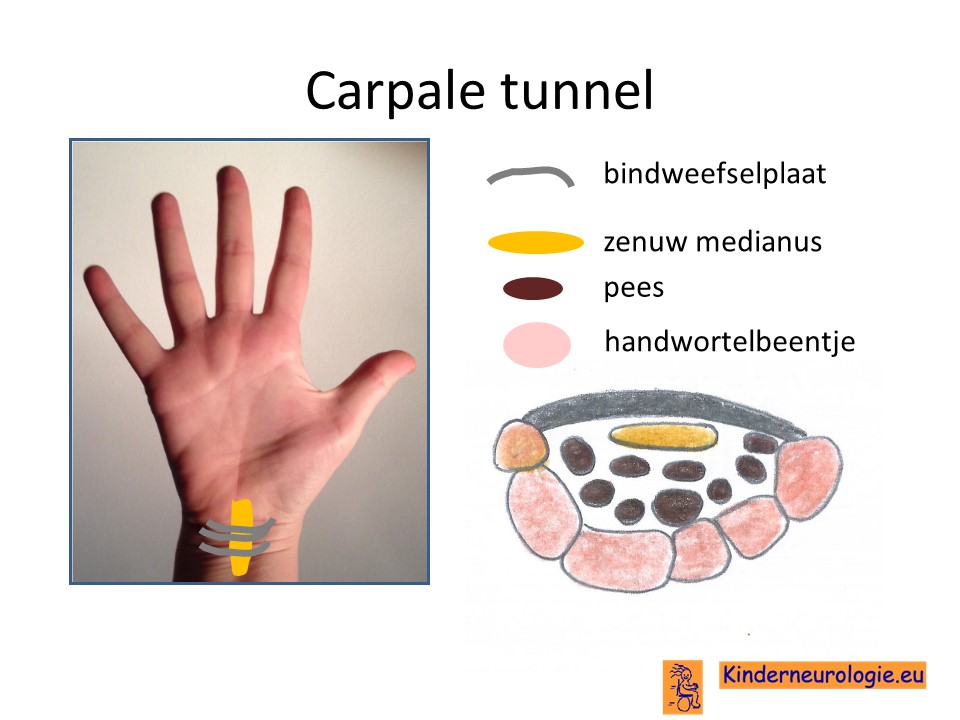 Carpaal tunnel